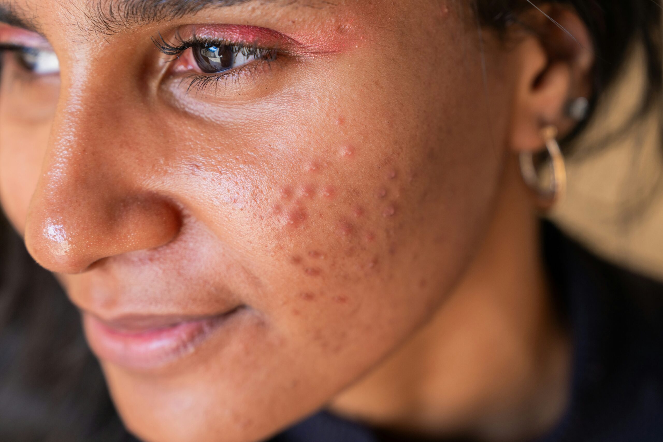 Woman with acne